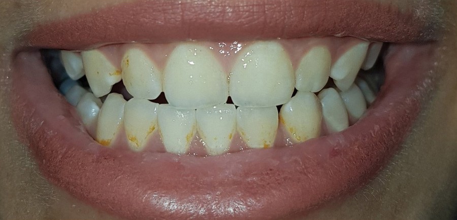 Before Whitening-Laser 1-1